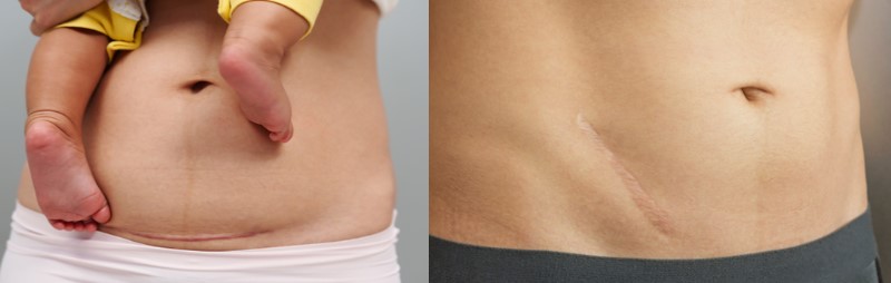 Scar marks on the abdomen of a woman and a man. 