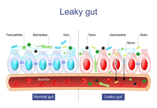 Leaky gut, showing tight junctions between cells vs leaky gut with broken junctions and toxins leaking out into the blood.