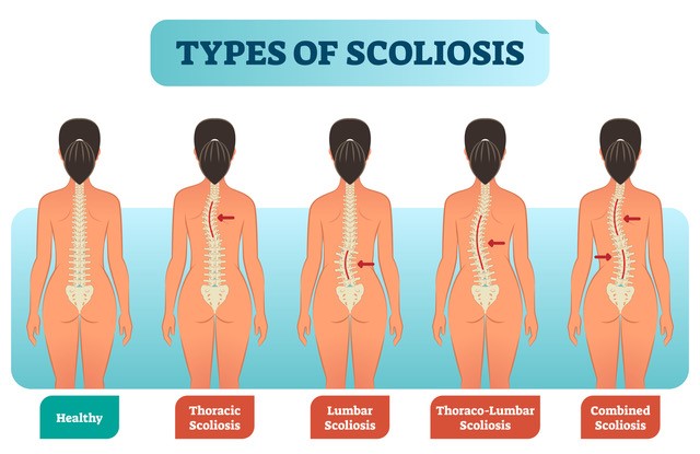 Different types of scoliosis affecting the spine.