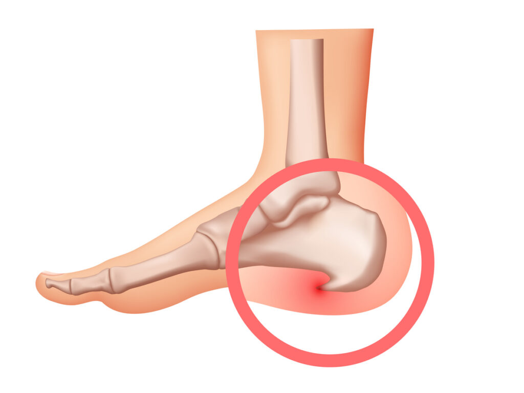 Heel spur illustration. Design elements on the theme of plantar fasciitis.